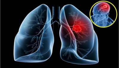 Ung thư phổi giai đoạn cuối di căn