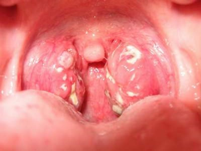 Dấu hiệu nhận biết sớm ung thư vòm họng