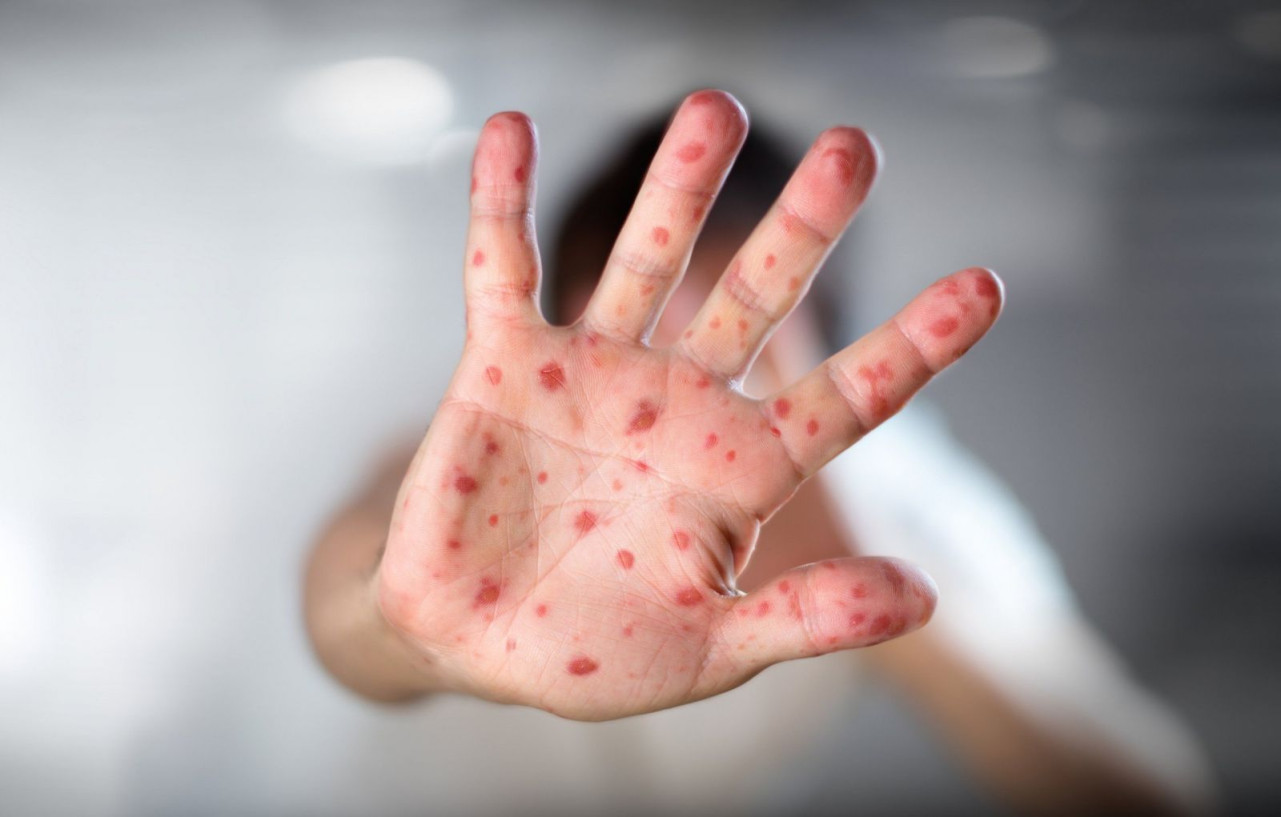 Dấu nhiện nhận biết, phân biệt bệnh sởi và sốt phát ban ở trẻ