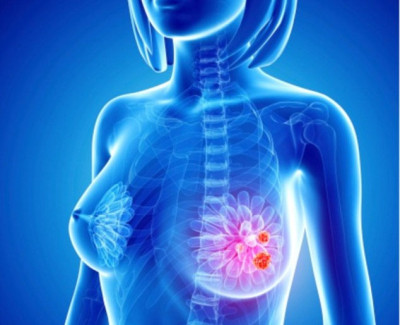 SOS các yếu tố nguy cơ gây ung thư vú ở nữ giới