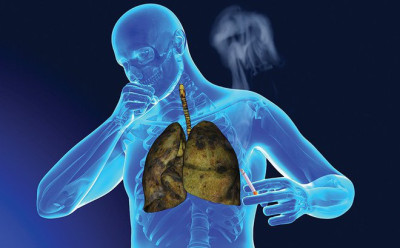 Thuốc lá: Nguyên nhân chính dẫn đến ung thư phổi