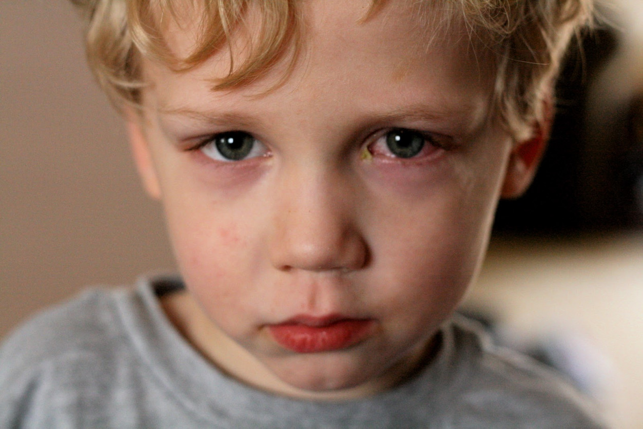 Bệnh đau mắt đỏ có nguy hiểm không?