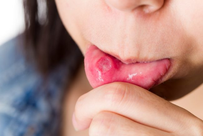 Nguyên nhân và dấu hiệu khi trẻ bị nhiệt miệng