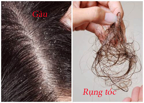 Cách điều trị hiệu quả tóc bị gàu và rụng nhiều?
