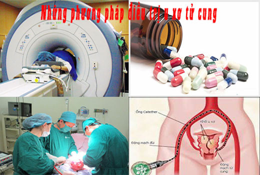 Phương pháp điều trị u xơ tử cung