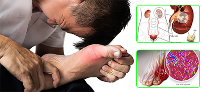 Chẩn đoán và điều trị bệnh gout